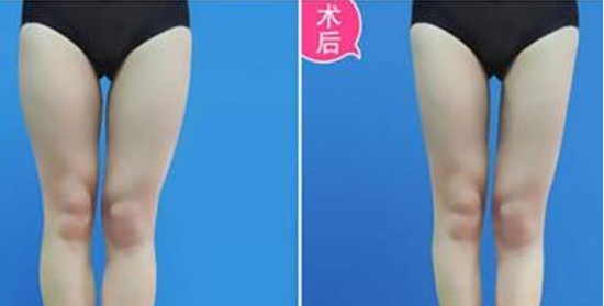 大腿粗,伤不起,我决定做超声波减肥066 大腿粗,伤不起,我决定做超声波减肥066
