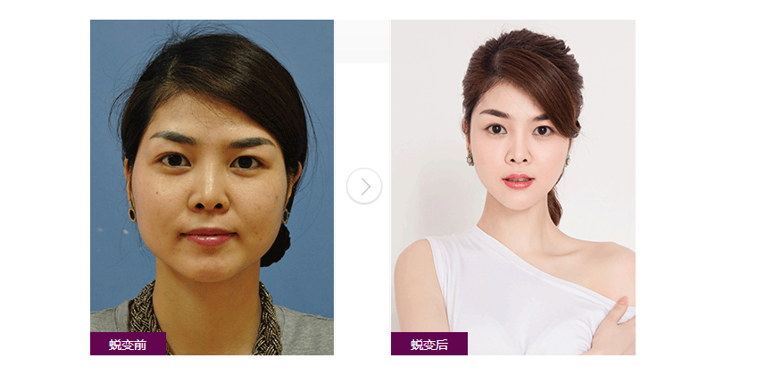 梁医生,感谢你超声波祛眼袋技能的专业519 梁医生,感谢你超声波祛眼袋技能的专业519