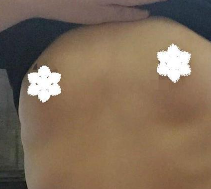 超声波自体脂肪丰胸后我的挺拔人生开始了~~103 超声波自体脂肪丰胸后我的挺拔人生开始了~~103