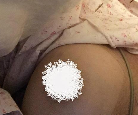超声波自体脂肪丰胸后我的挺拔人生开始了~~103 超声波自体脂肪丰胸后我的挺拔人生开始了~~103