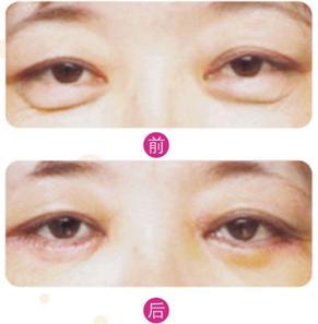 离婚女人的美容日记1:做超声波祛眼袋分享290 离婚女人的美容日记1:做超声波祛眼袋分享290