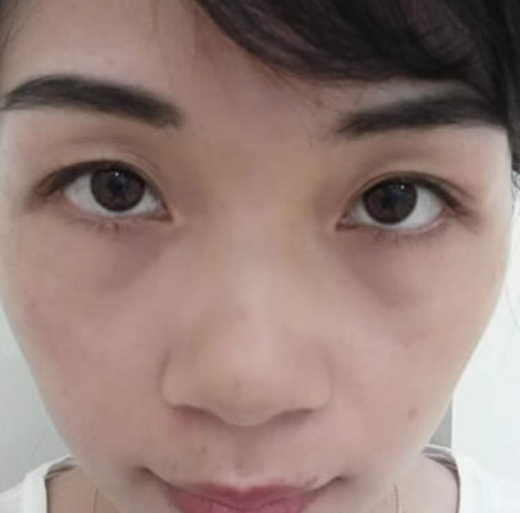 超声波祛眼袋是你变美的最好的选择428 超声波祛眼袋是你变美的最好的选择428