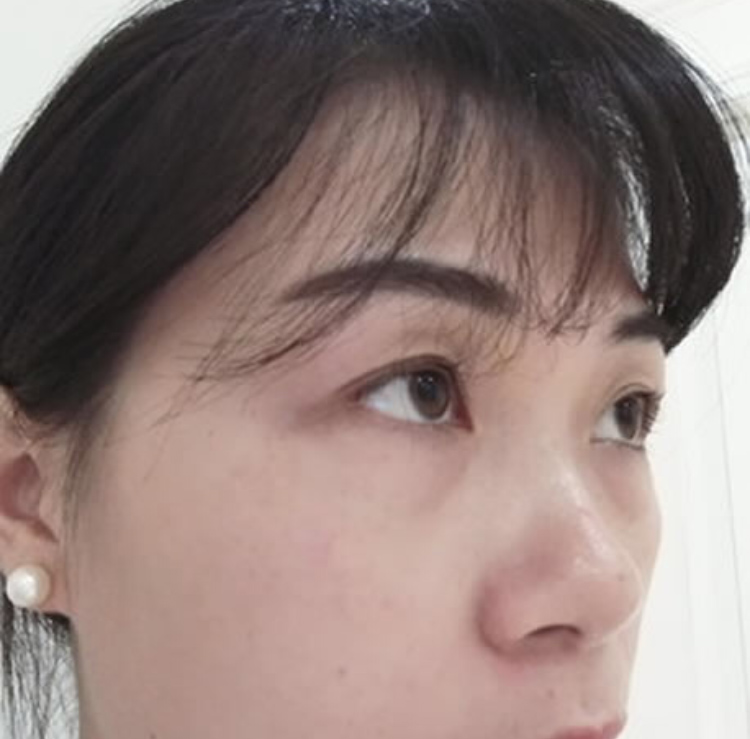 超声波祛眼袋是你变美的最好的选择428 超声波祛眼袋是你变美的最好的选择428