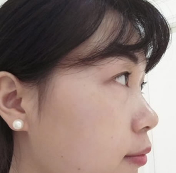 超声波祛眼袋是你变美的最好的选择428 超声波祛眼袋是你变美的最好的选择428