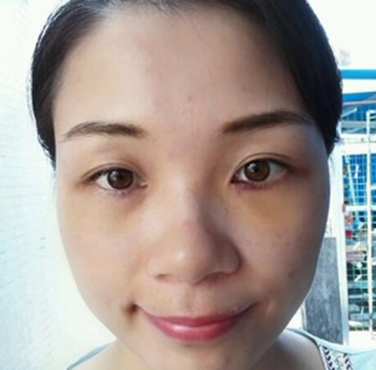 超声波祛眼袋是你变美的最好的选择428 超声波祛眼袋是你变美的最好的选择428