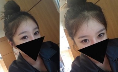 超声波双眼皮,给我带来了更多财富229 超声波双眼皮,给我带来了更多财富229