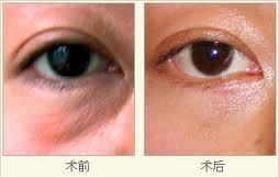 做le超 声 波双眼 皮手术,没人再来说闲话le 做le超 声 波双眼 皮手术,没人再来说闲话le