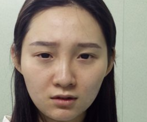 超声波双眼皮解决掉我的单眼皮421 超声波双眼皮解决掉我的单眼皮421