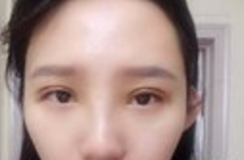超声波双眼皮解决掉我的单眼皮421 超声波双眼皮解决掉我的单眼皮421