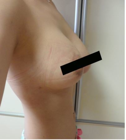 超声波自体脂肪丰胸让我也时髦起来了035 超声波自体脂肪丰胸让我也时髦起来了035