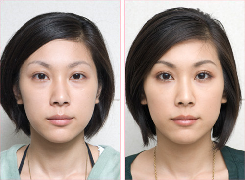 超声波祛眼袋是中年女人救命稻草769 超声波祛眼袋是中年女人救命稻草769