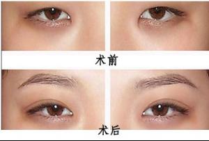 超 声 波双眼 皮让wǒ收获完美爱情
