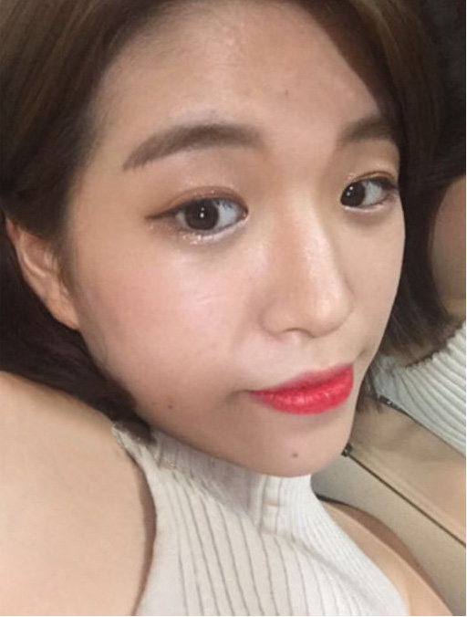超 声 波双眼 皮让成为年会得亮点 超 声 波双眼 皮让成为年会得亮点