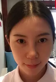 做不开刀隆鼻怎么就这么厉害啊585 做不开刀隆鼻怎么就这么厉害啊585
