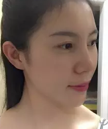 做不开刀隆鼻怎么就这么厉害啊585 做不开刀隆鼻怎么就这么厉害啊585
