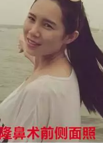 做不开刀隆鼻怎么就这么厉害啊585 做不开刀隆鼻怎么就这么厉害啊585