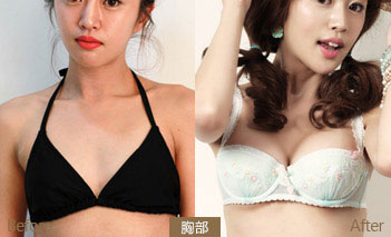 超声波丰胸给我不一样的人生388 超声波丰胸给我不一样的人生388