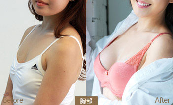 超声波丰胸给我不一样的人生388 超声波丰胸给我不一样的人生388