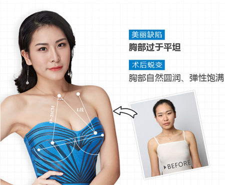 自体脂肪丰胸安全有保证 自体脂肪丰胸安全有保证