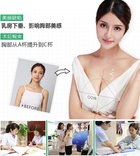 自体脂肪丰胸安全有保证 自体脂肪丰胸安全有保证