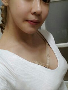 自体脂肪丰胸让你拥有令老公满意的胸部233 自体脂肪丰胸让你拥有令老公满意的胸部233