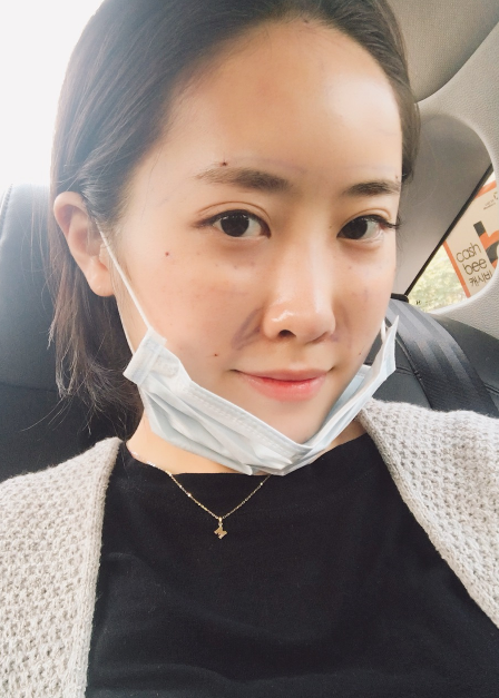 想要拥有如高圆圆一样的不老容颜就来超雅做超声波提升术331