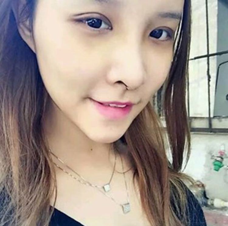不开刀隆鼻爸妈支持我的一个手术985 不开刀隆鼻爸妈支持我的一个手术985
