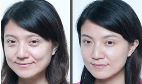 超声波去眼袋的体验672 超声波去眼袋的体验672