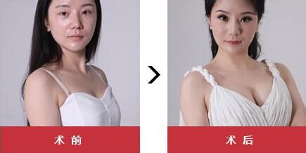 超 声 波丰胸技术更加安全可靠 超 声 波丰胸技术更加安全可靠