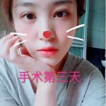 从清秀晋级到美丽——超声波双眼皮手术912 从清秀晋级到美丽——超声波双眼皮手术912