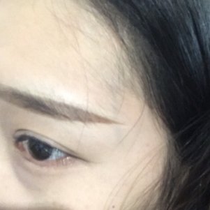 彻底摆脱大眼袋——超声波去眼袋手术002 彻底摆脱大眼袋——超声波去眼袋手术002