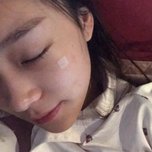 彻底摆脱大眼袋——超声波去眼袋手术002 彻底摆脱大眼袋——超声波去眼袋手术002