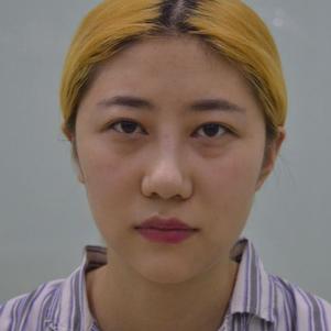 超声波去眼袋是,比美颜软件还给力224 超声波去眼袋是,比美颜软件还给力224