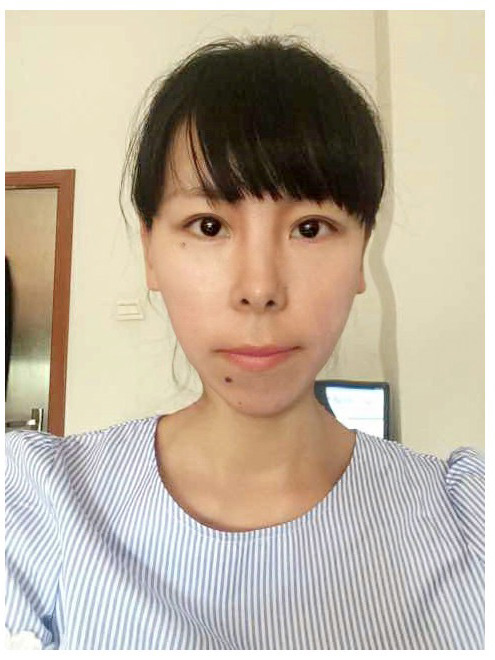 高中老师永久祛眼袋选择超 声 波 高中老师永久祛眼袋选择超 声 波