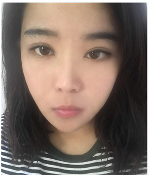 操劳出来的眼袋,去重庆超雅成功祛眼袋。079 操劳出来的眼袋,去重庆超雅成功祛眼袋。079