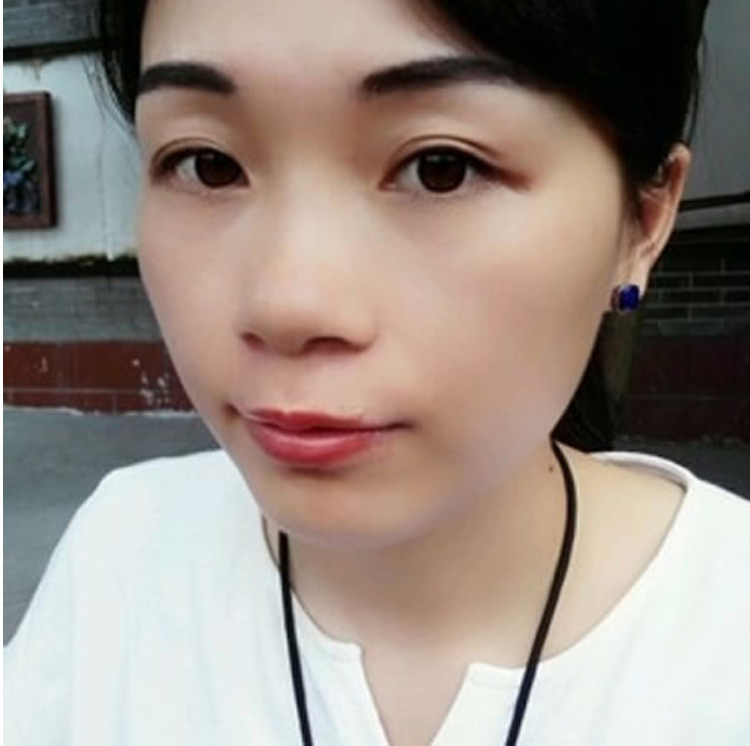 超 声 波祛眼袋真得长久有效吗? 超 声 波祛眼袋真得长久有效吗?