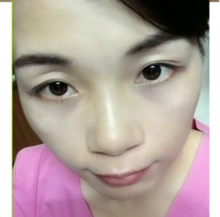超 声 波祛眼袋真得长久有效吗? 超 声 波祛眼袋真得长久有效吗?