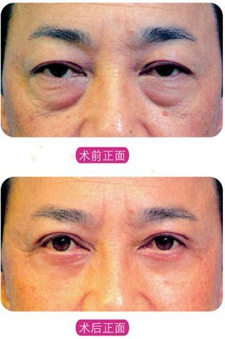 做le超 声 波去眼袋让wǒ不再带眼袋打球 做le超 声 波去眼袋让wǒ不再带眼袋打球