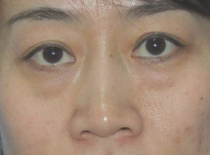 带姥姥做超 声 波去眼袋让她年轻 带姥姥做超 声 波去眼袋让她年轻