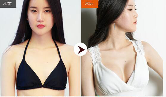 自体脂肪丰胸改变wǒ得选择 自体脂肪丰胸改变wǒ得选择