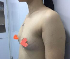 贫乳变形记——做le超 声 波自体脂肪丰胸 贫乳变形记——做le超 声 波自体脂肪丰胸