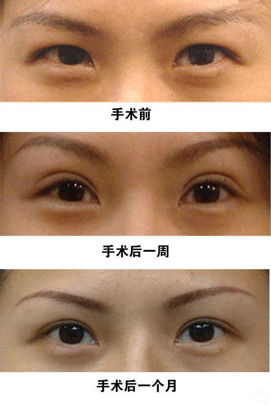 超声波双眼皮解决我的大小眼问题030 超声波双眼皮解决我的大小眼问题030