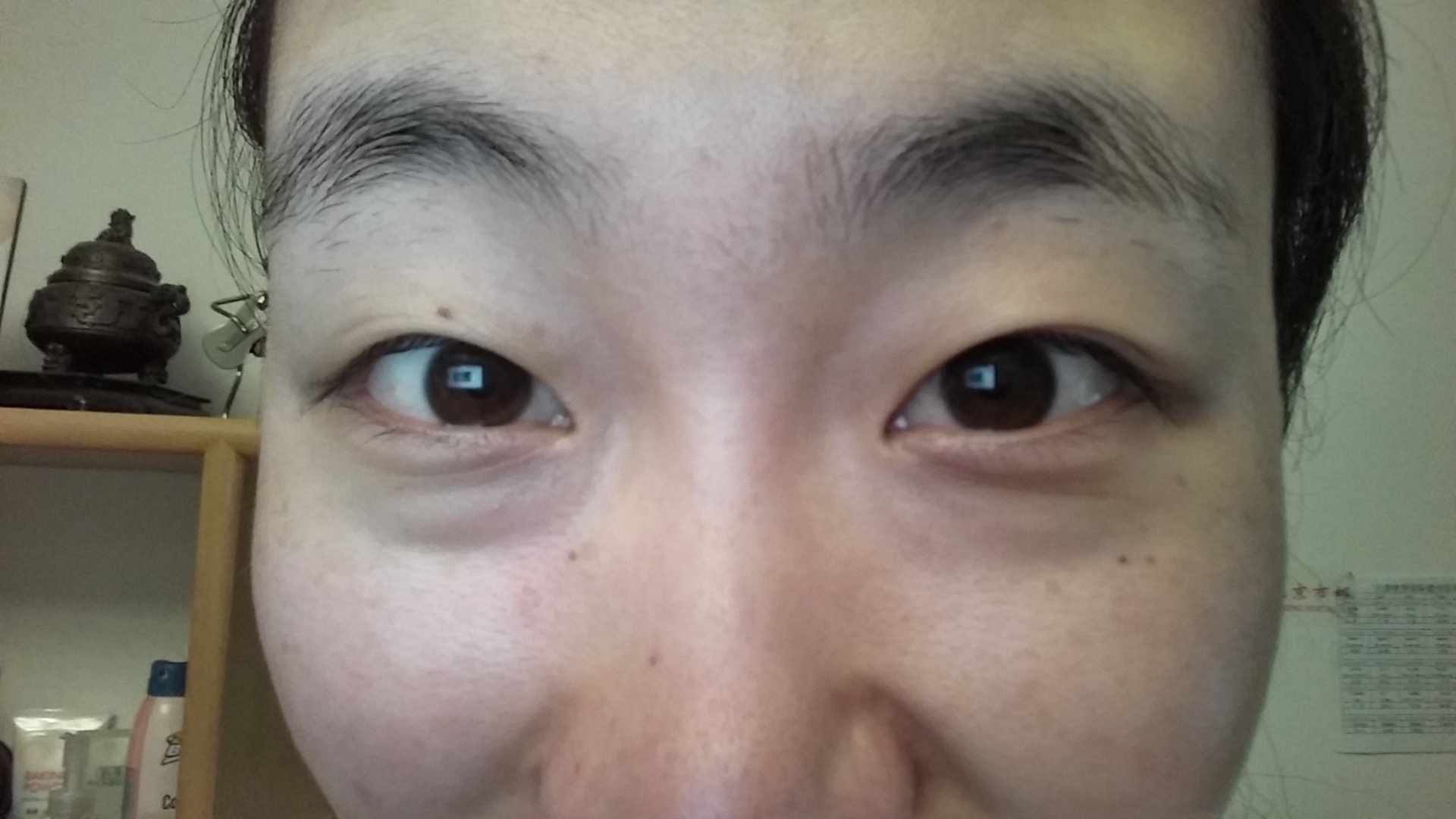 超声波祛眼袋让我看起来像个学生596 超声波祛眼袋让我看起来像个学生596