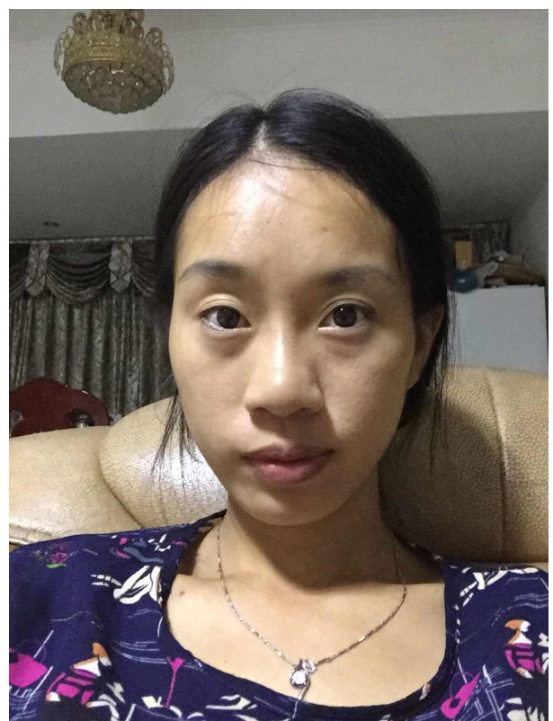 饭店合伙人做le超 声 波去眼袋,眼袋都没有le 饭店合伙人做le超 声 波去眼袋,眼袋都没有le