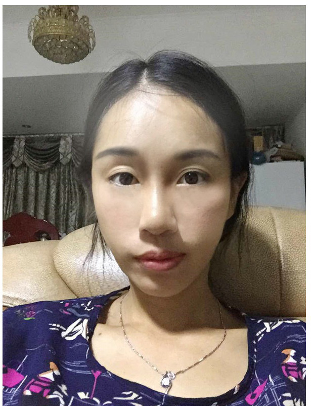 饭店合伙人做le超 声 波去眼袋,眼袋都没有le 饭店合伙人做le超 声 波去眼袋,眼袋都没有le