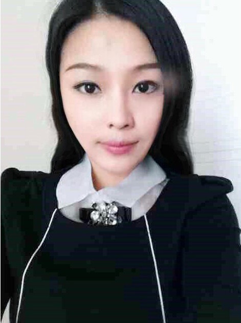 网红承认做了超声波祛眼袋手术936 网红承认做了超声波祛眼袋手术936