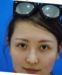 跟着朋友的脚步去做了超声波去眼袋483 跟着朋友的脚步去做了超声波去眼袋483