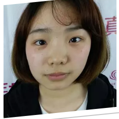 爱美达人金金分享隆鼻心得916 爱美达人金金分享隆鼻心得916