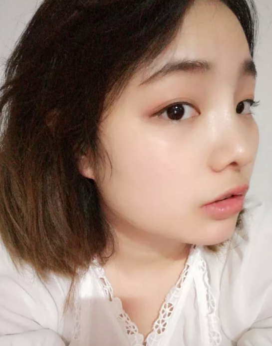 爱美达人金金分享隆鼻心得916 爱美达人金金分享隆鼻心得916