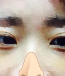 超声波去眼袋咋样啊?我来说说吧812 超声波去眼袋咋样啊?我来说说吧812